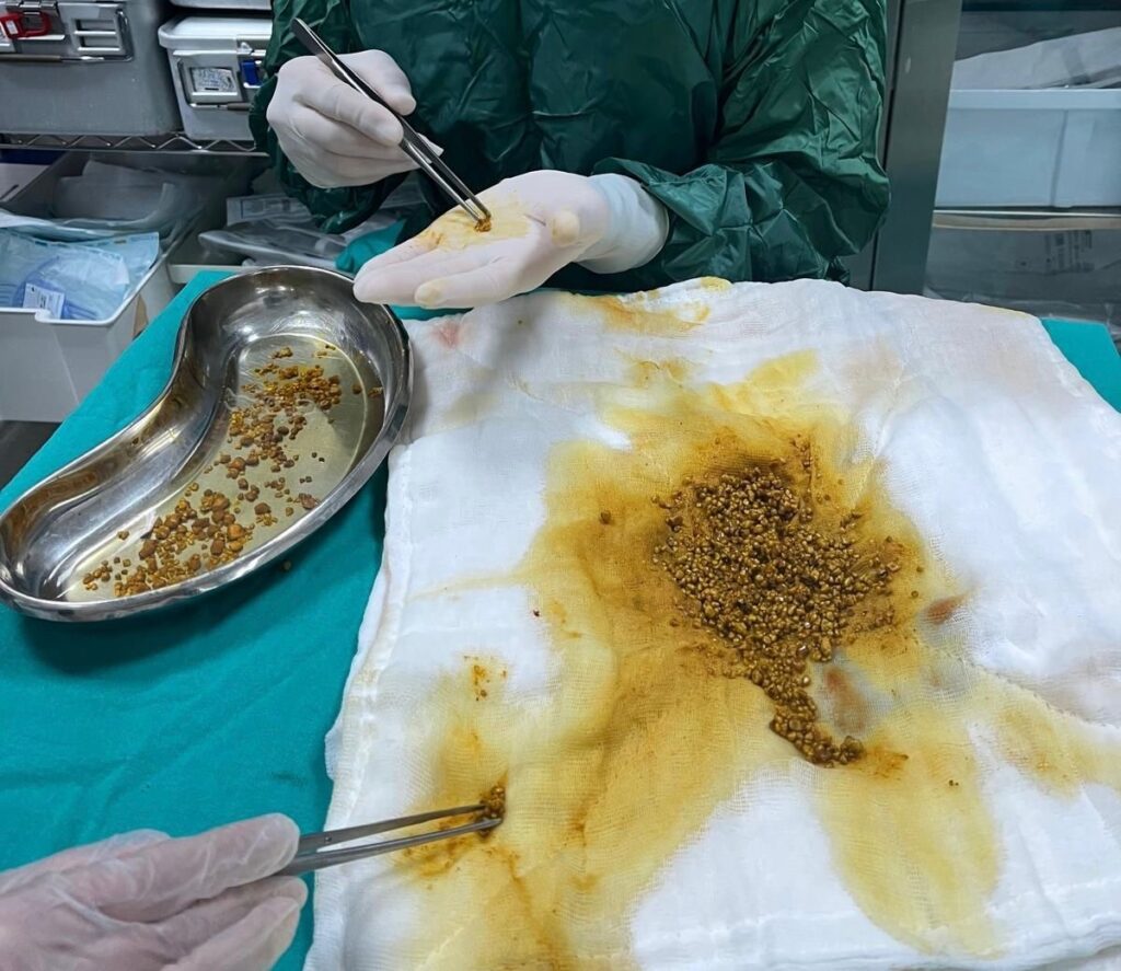 Bingöl’de Tıp Literatürüne Nadir Girecek Operasyon: Safra Kesesinden 2 Bin 67 Taş Çıkarıldı